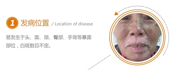老年白癜风常见的四大症状